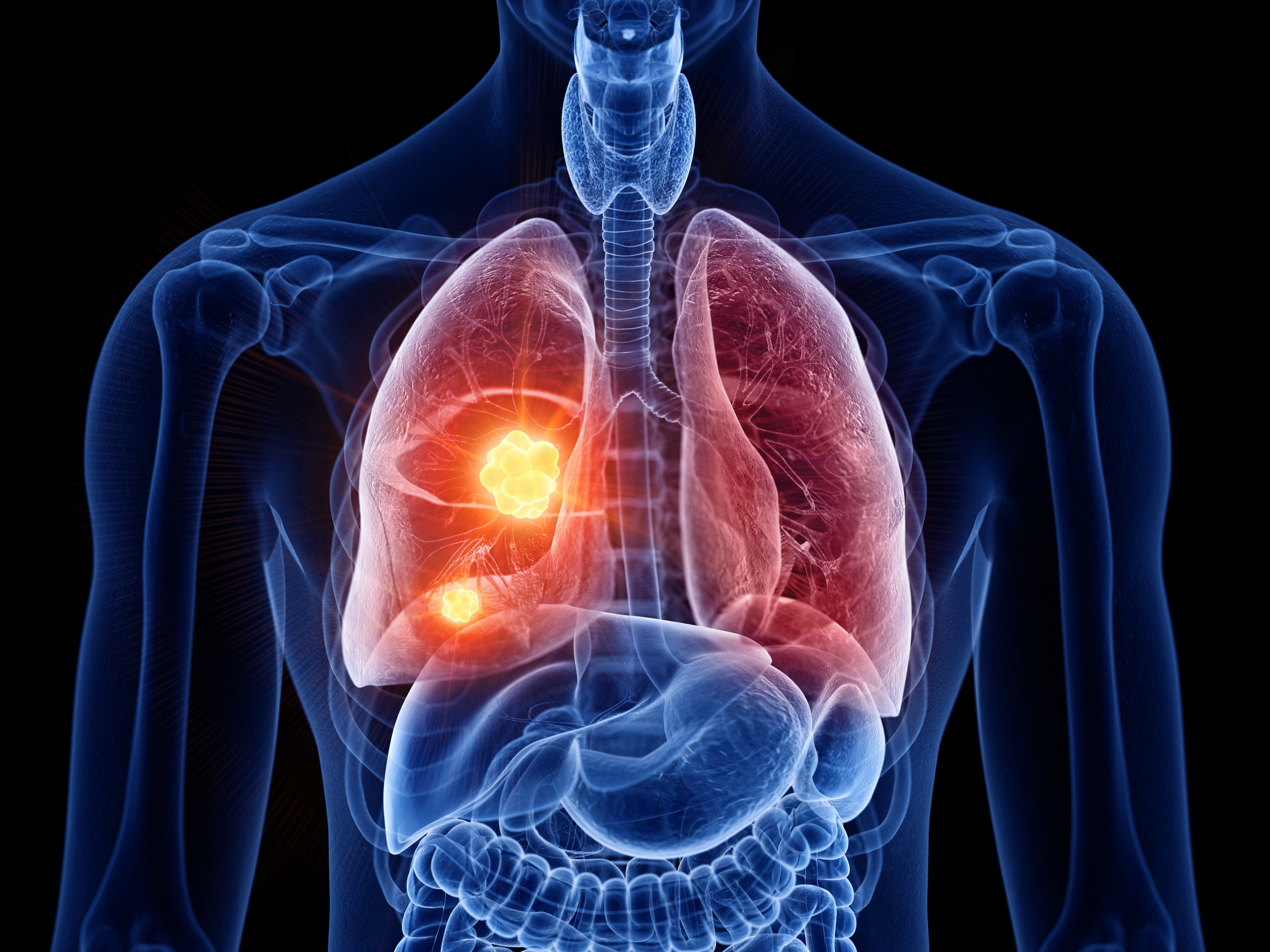 Thoracic & Lung Cancer: Low-Dose CT Screening & Minimally Invasive VATS Lobectomy